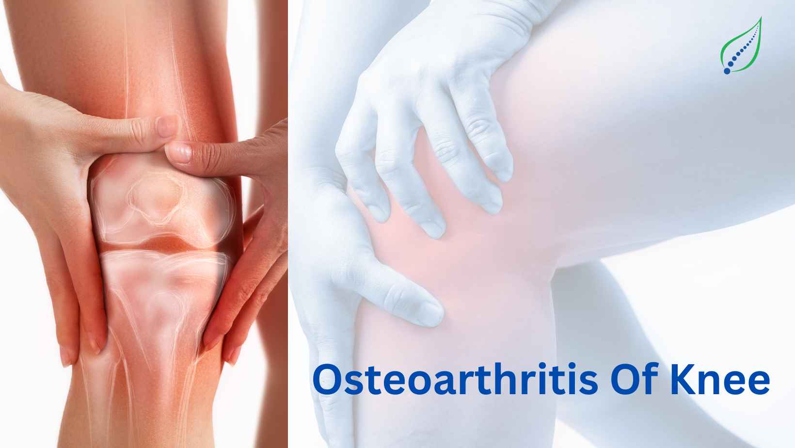 Osteoarthritis Of Knee